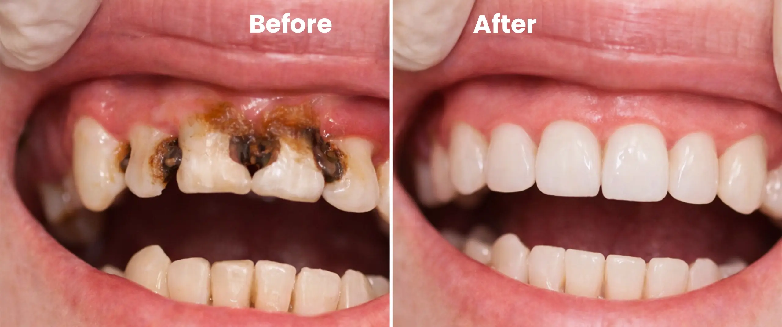 Professional dental exam and teeth cleaning procedure removing plaque and tartar for healthy teeth