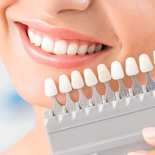 Dental-Veneers