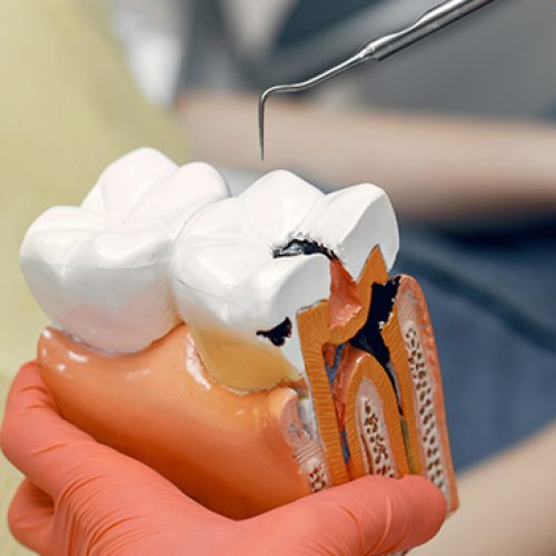 Root-Canal-Therapy