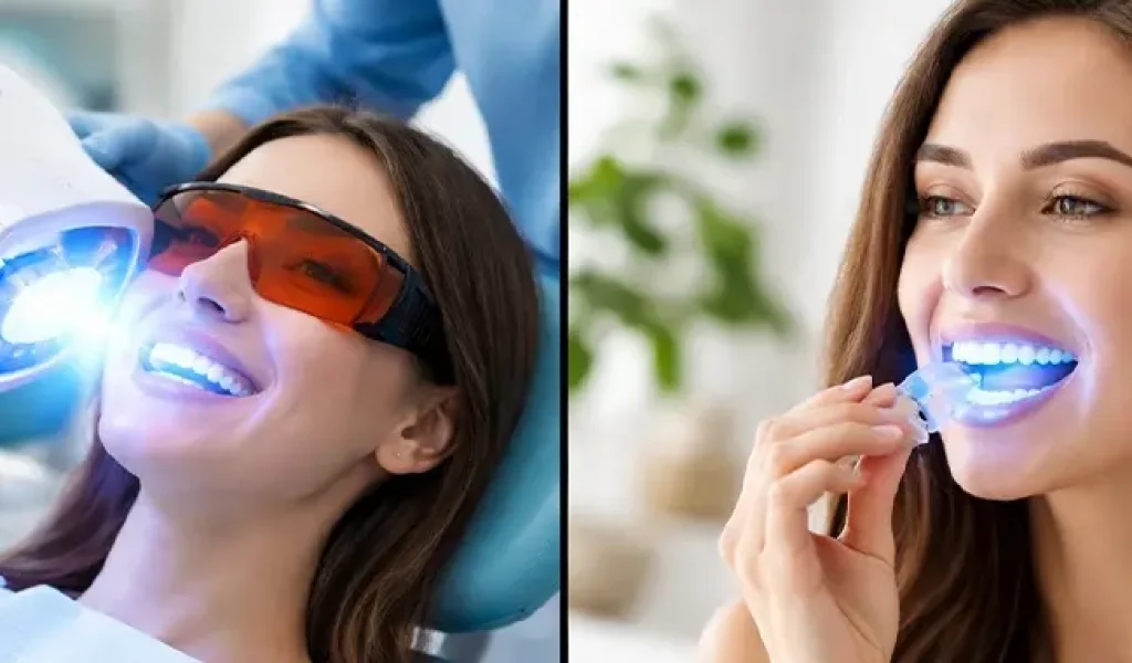 Teeth Whitening Professional vs At-Home – Which Is Better