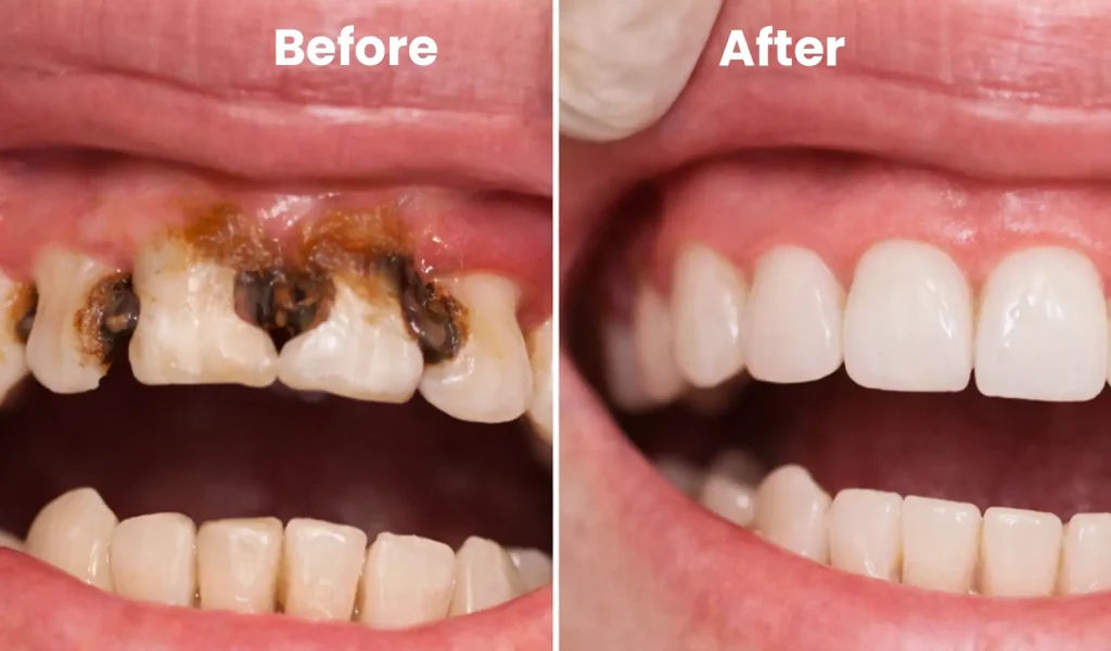 Professional dental exam and teeth cleaning procedure removing plaque and tartar for healthy teeth
